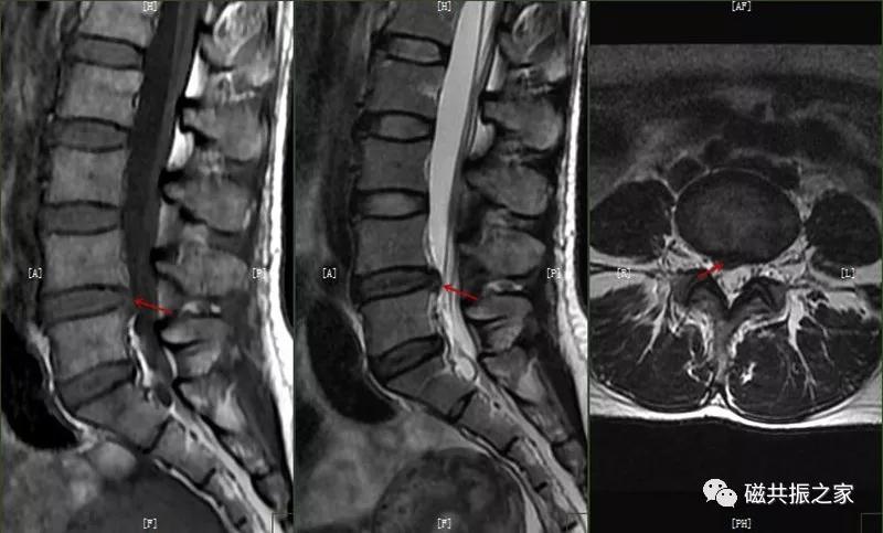 腰椎有哪些病变,腰椎病变有几种