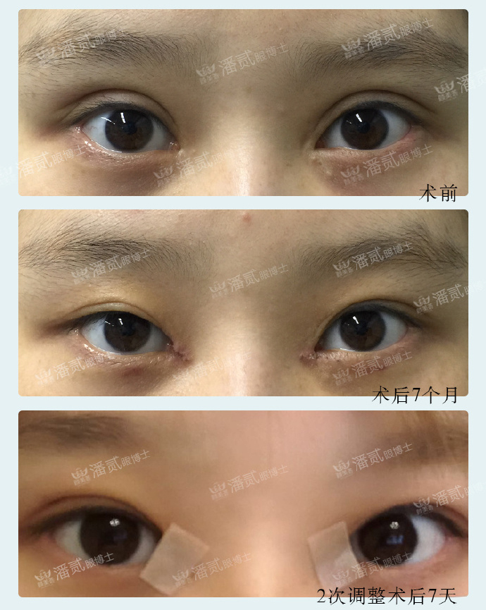 双眼皮太深显老怎么修复,双眼皮失败后修窄