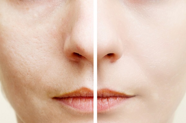 如何改善毛孔粗大有黑头,脸颊两侧毛孔粗大毛孔里有黑头