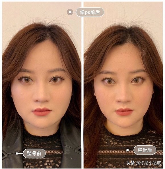 日式小颜整骨是真的假的,不动刀脸部轮廓整形多少钱