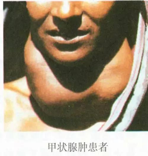 专家提醒:别让甲状腺疾病影响你的公务员体检