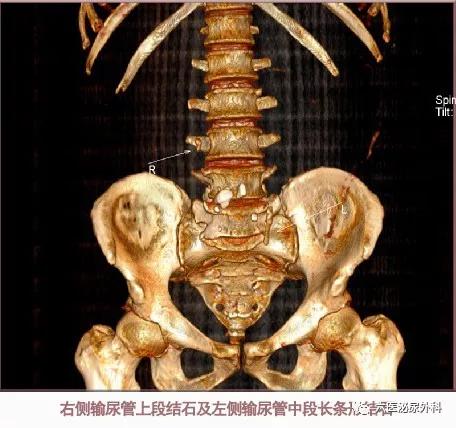 肾绞痛好难受,肾绞痛你痛到哪个程度