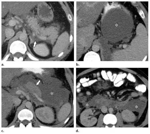 简述急性胰腺炎影像学表现,有关急性胰腺炎疼痛的图片