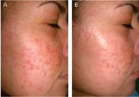 不同痘坑凹洞擦什么药膏,不同痘坑怎么修复