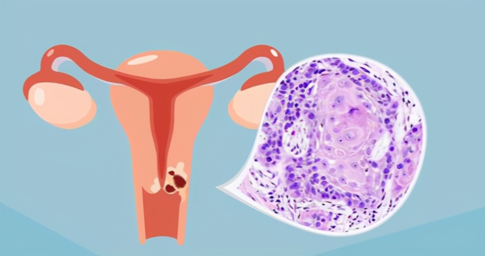 宫颈癌复发用什么药好使,宫颈癌复发的患者可选用的方案是