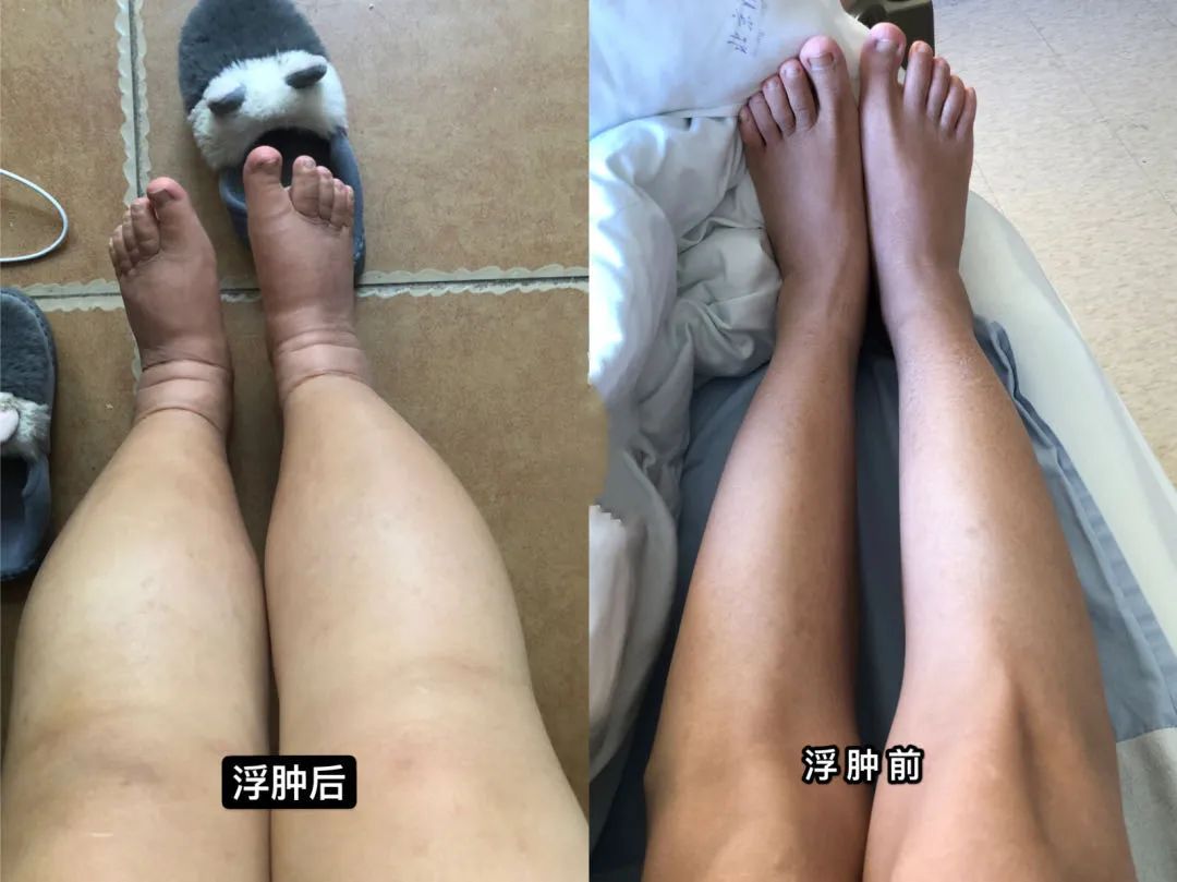 2年，从肌酐100到透析！绝望中的自我救赎之路