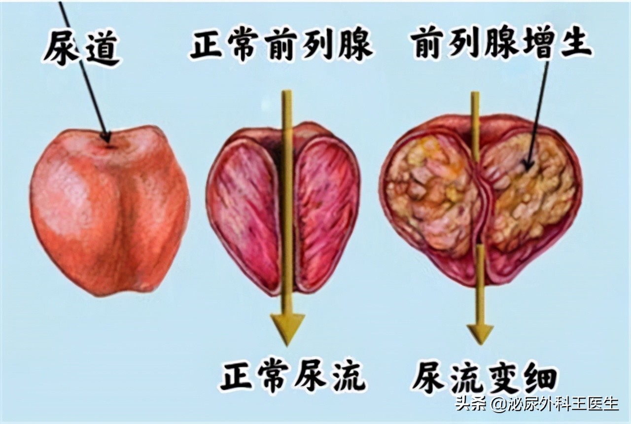 坦索罗辛不仅能改善尿频，还能用于这几种常见的男科疾病，好用