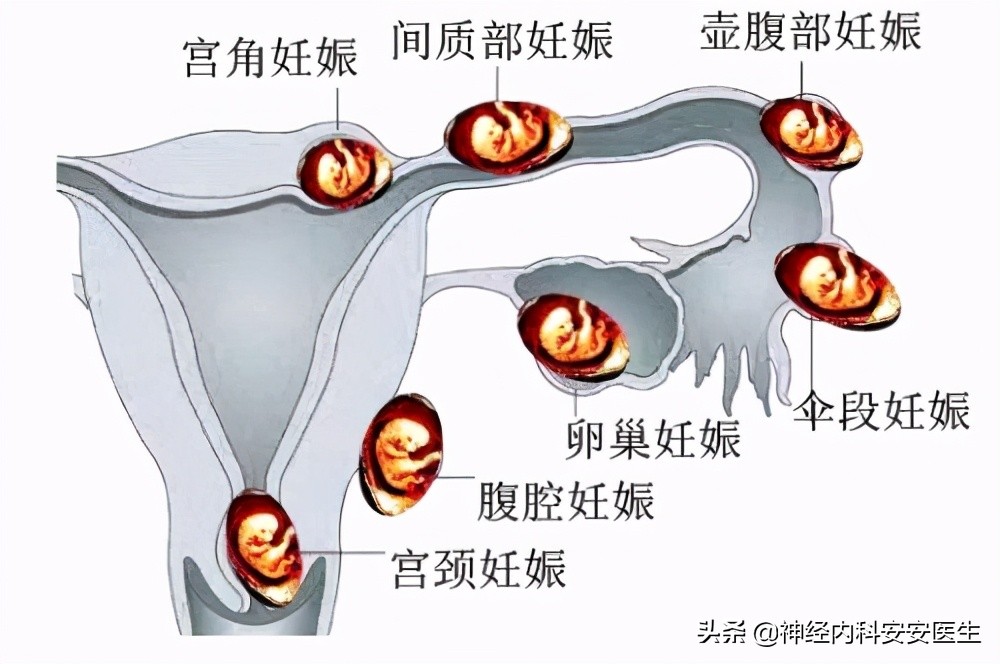 月经总是推迟如果受孕了怎么判断,如果发现例假迟来了怎么办