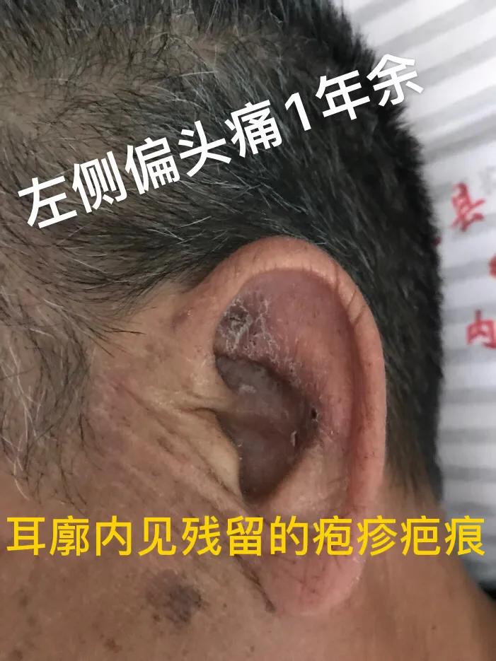 典型先兆性偏头痛怎么治,偏头痛左侧痛