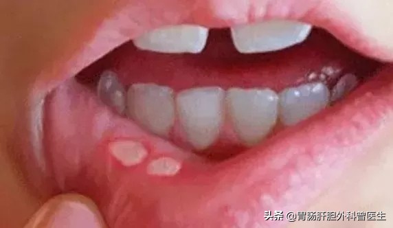 与口腔溃疡的决战,与口腔溃疡永远和解