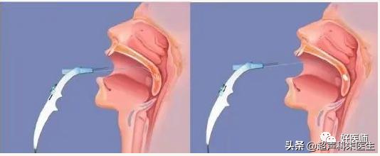 咽喉疾病科普知识,咽喉疾病动画科普视频