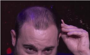 到什么程度适合植发,哪种植发创伤最小