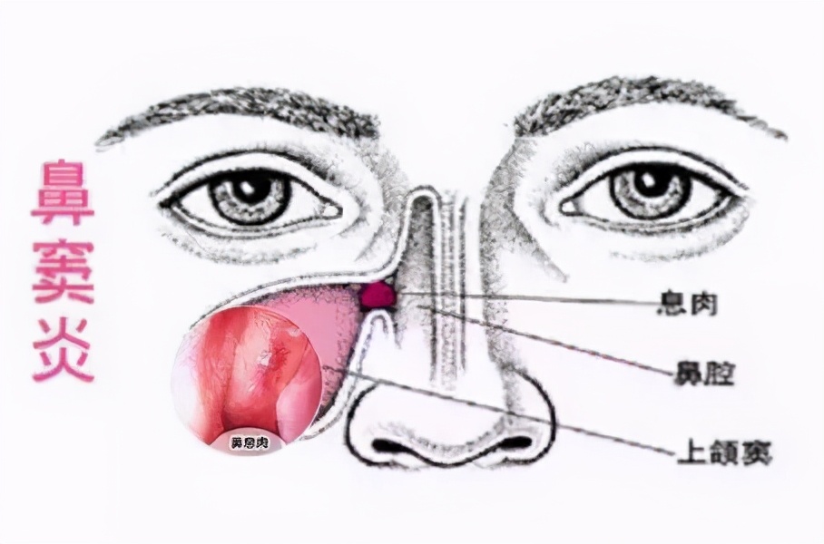 宝宝突然流脓鼻涕是慢性鼻窦炎吗,流脓鼻涕10天以上就是鼻窦炎吗