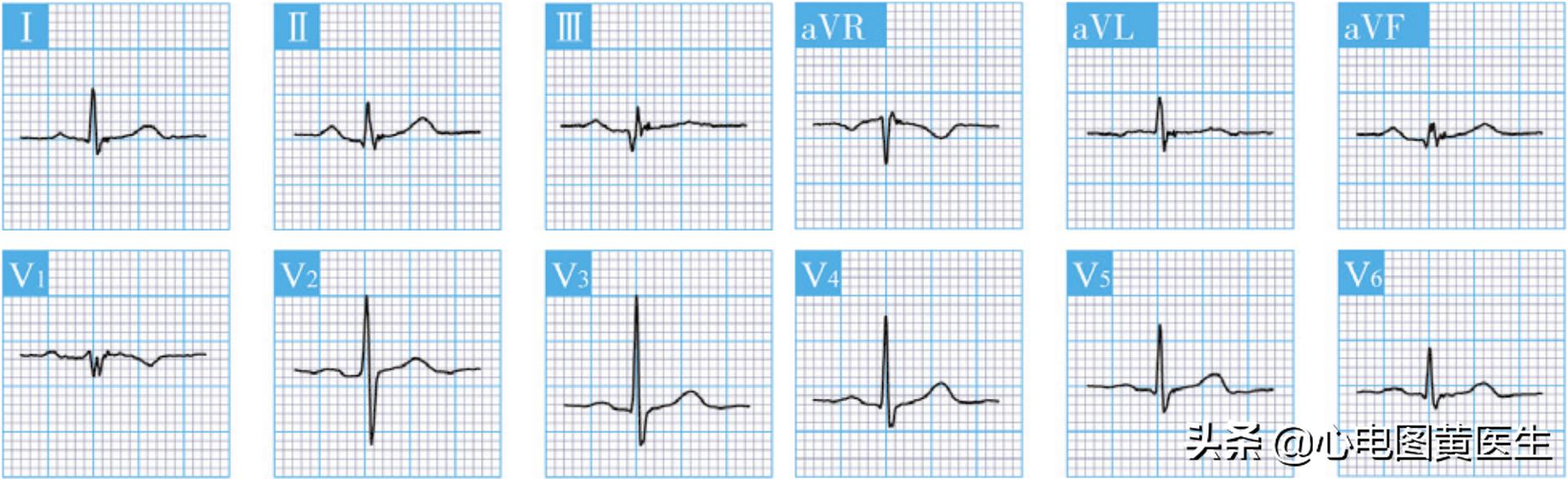 心电图q波异常但冠脉造影正常,病理性q波与异常q波心电图