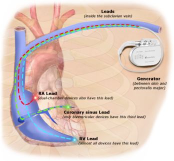 一文盘点：治疗室速的8种方法