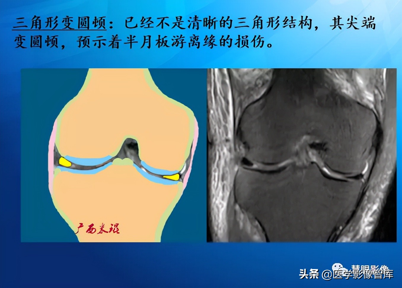 膝关节半月板损伤的解剖结构图,半月板mri解剖图解