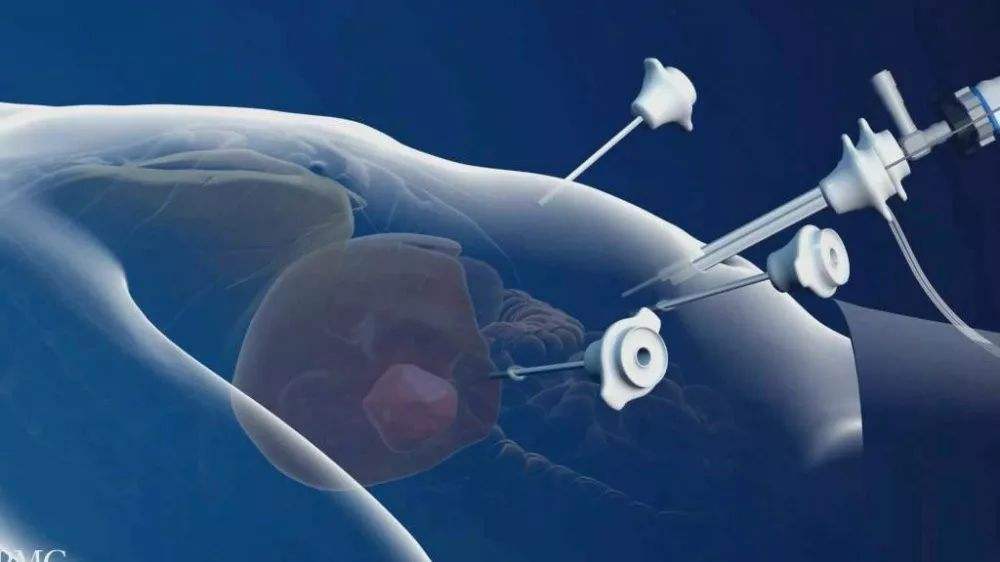 胸椎压缩性骨折微创手术利弊,哪些人不适合做微创手术