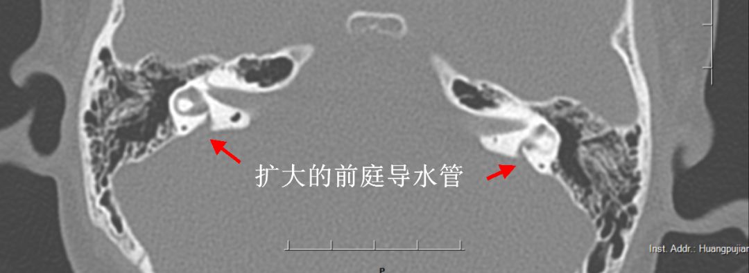 突然耳聋治愈率是多少,青岛耳聋去哪治疗