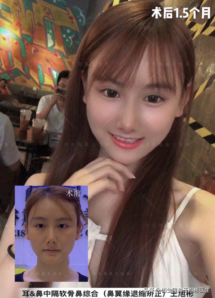 王旭彬：朝天鼻、露鼻孔，模特菲菲短鼻矫正手术后1.5个月