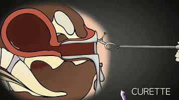 27岁未婚女孩6年做了17次人流：无痛人流，没你想得那么简单