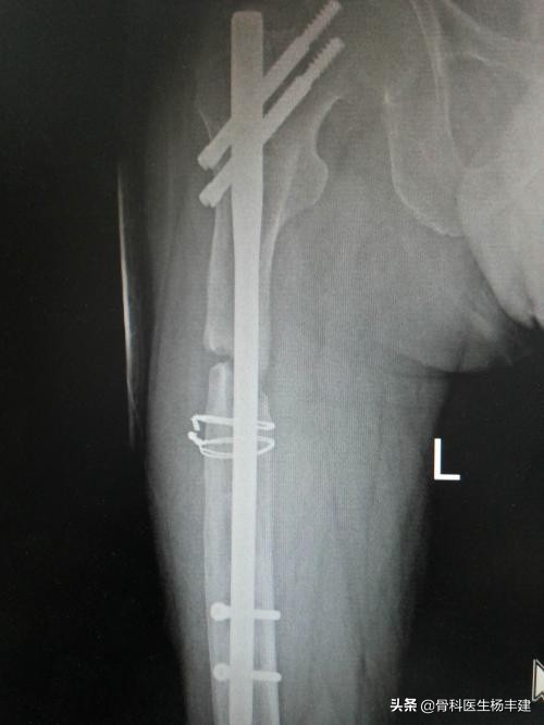 骨折手术后需要注意,什么情况下容易出现钢板断裂?