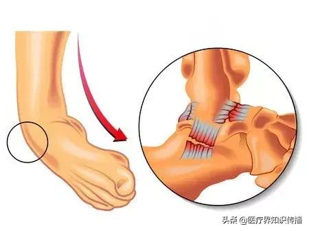 老是崴脚用什么保护,老是崴脚用什么药