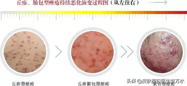 痘痘十大真相,痘痘大全图解