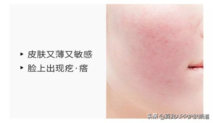 刷酸爆闭口要不要继续刷,刷酸祛闭口几天能有效果