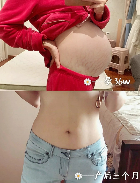 祛妊娠纹的产品亲测,明星用的祛妊娠纹产品