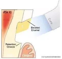 改变刷牙方式楔状缺损就会停止吗,刷牙导致楔状缺损牙齿会断么