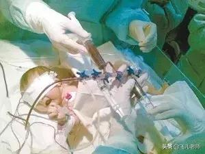 出生6天的婴儿黄疸高怎么办,为什么新生儿有黄疸要换血