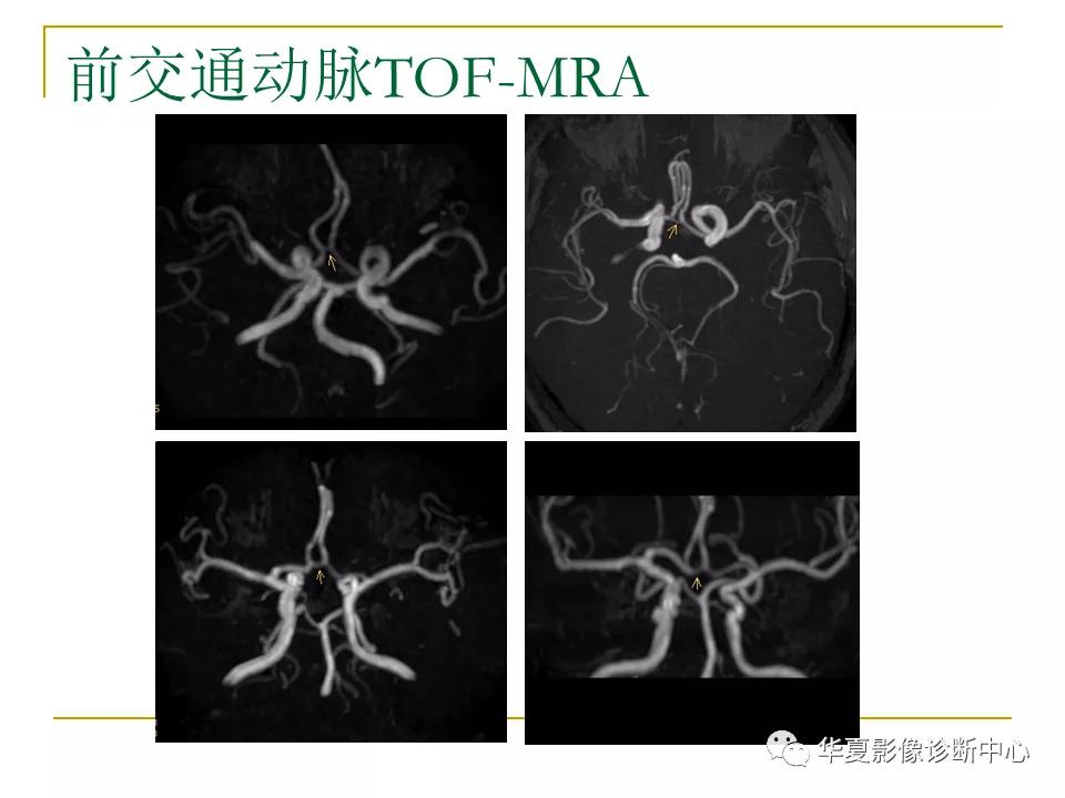 中国人脑立体定向mri应用解剖图谱,脑mri示意图