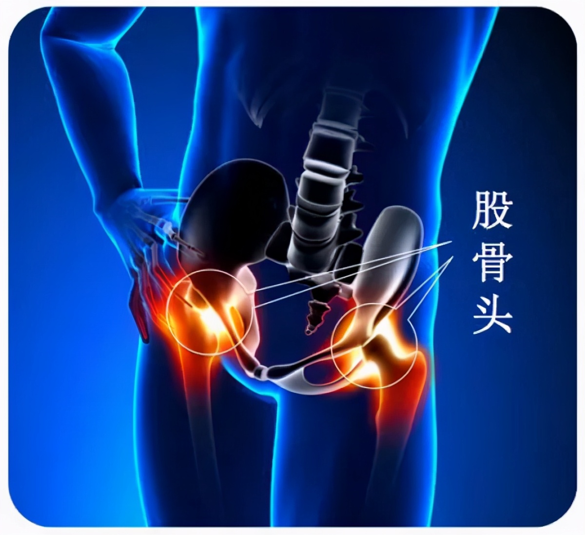 髋关节疼痛警惕股骨头坏死症状,股骨头坏死用手敲打会感到疼痛吗