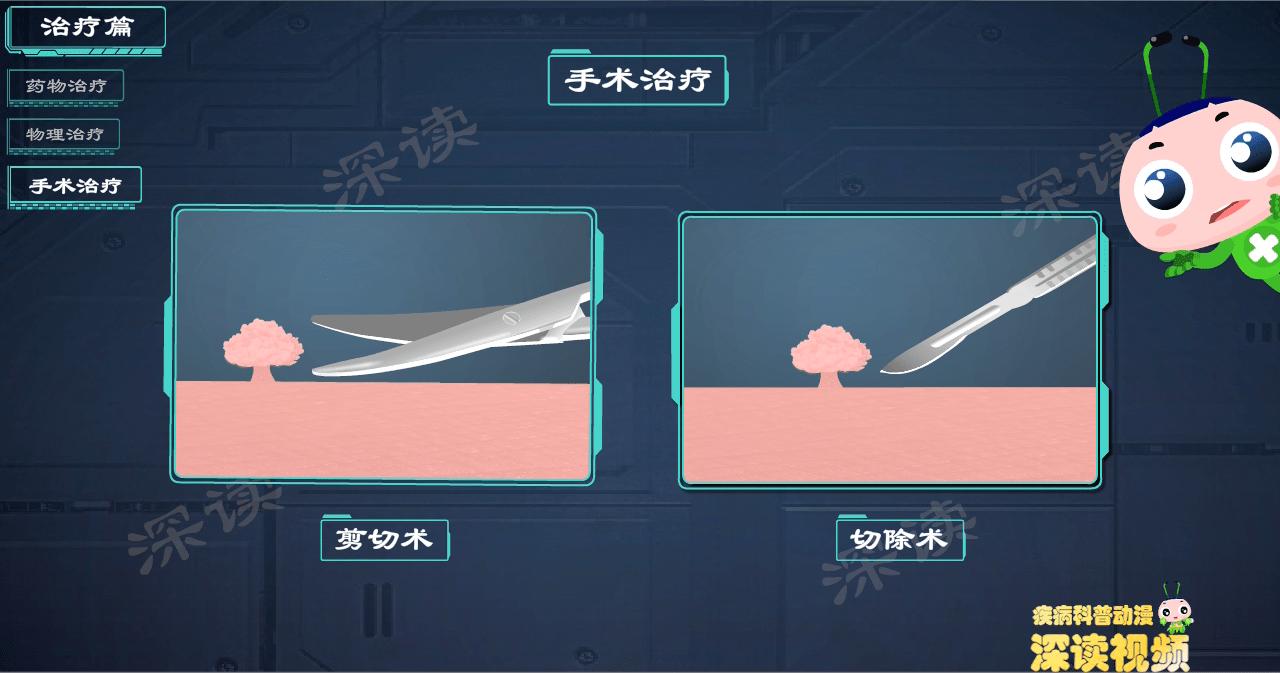 液氮冷冻治疗尖锐湿疣,冷冻和激光治疗尖锐湿疣的效果