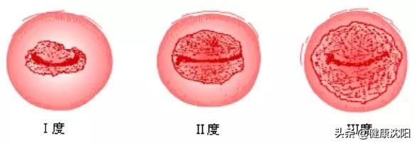 健康科普堂|关爱女性～关注宫颈