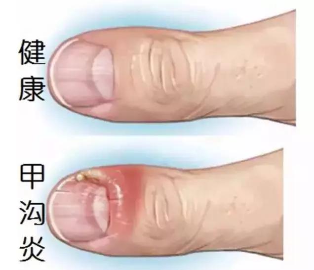 跑步脚上出现黑趾甲该怎么处理,跑步黑脚趾怎么处理