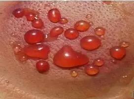 拔罐后为啥有的罐印有的深有的浅,拔罐对人是有好处还是有坏处