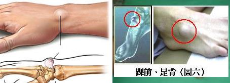 手腕腱鞘囊肿没肿但是痛怎么处理,手腕突然鼓起硬包摸起来不痛