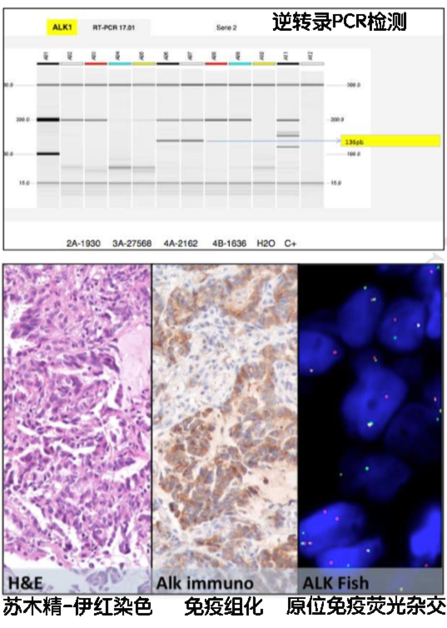 大便基因检测阴性可排除肠癌吗,检测肿瘤标志物注意事项