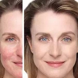 敏感肌用药膏抹还是用护肤品,敏感肌可以用大牌护肤品吗