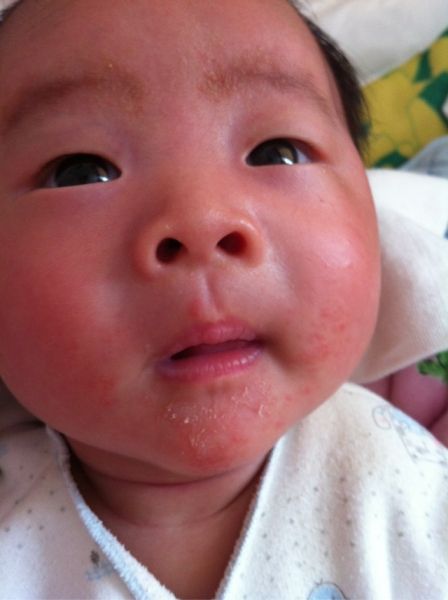 新生儿湿疹怎么护理最有效,新生儿屁股上有湿疹怎么护理