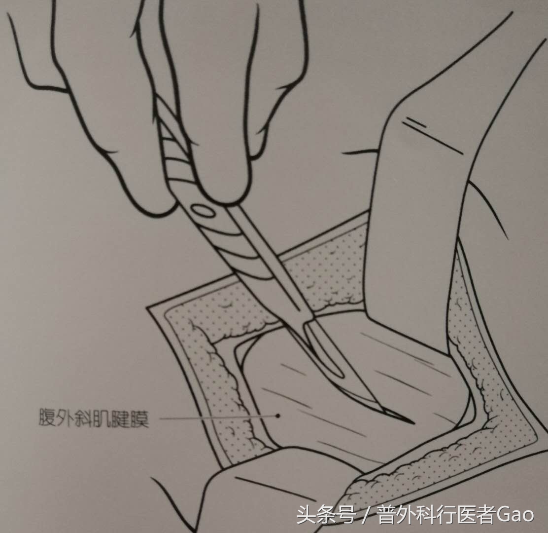 杏仁：一图一话全面解析阑尾的切除过程（干货，不懂医也学习了）