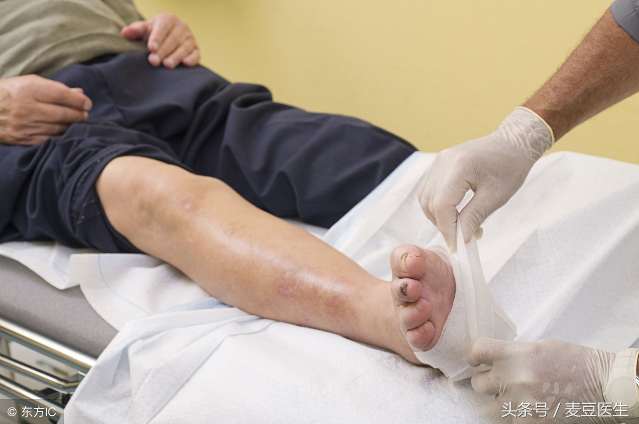 为什么糖尿病脚底会有洞,脚上的洞