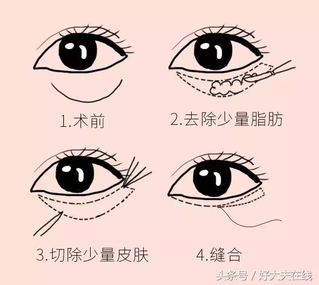 眼袋泪沟怎么去除男生,怎么去除眼袋和泪沟黑眼圈