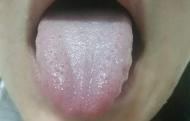 一例午后自觉低热患者在中医干预后的舌苔变化及其转归