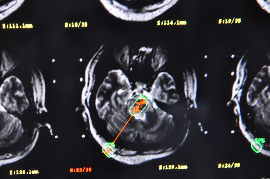 立体定向脑干血肿清除术,脑干血肿清除术