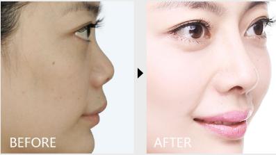 花了30万整的鼻子,花了10万整的鼻子