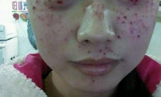 液氮祛斑和激光祛斑哪个效果好,超皮秒激光祛斑的危害与效果视频