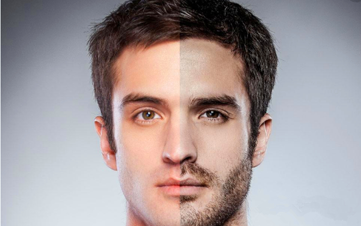 胡子种植好不好,胡子种植毛囊