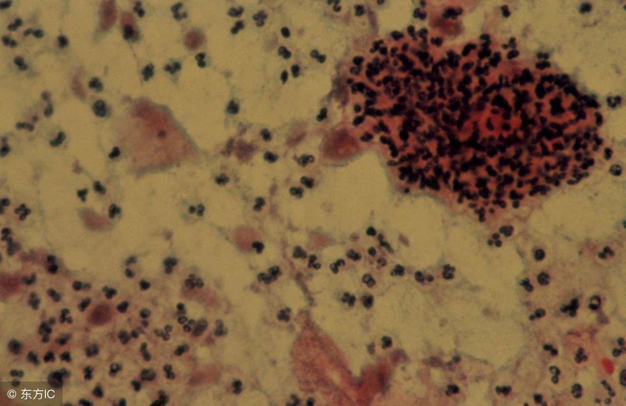 宫颈炎症状有哪些表现怎么治疗,宫颈炎是怎么引起来的有哪些症状